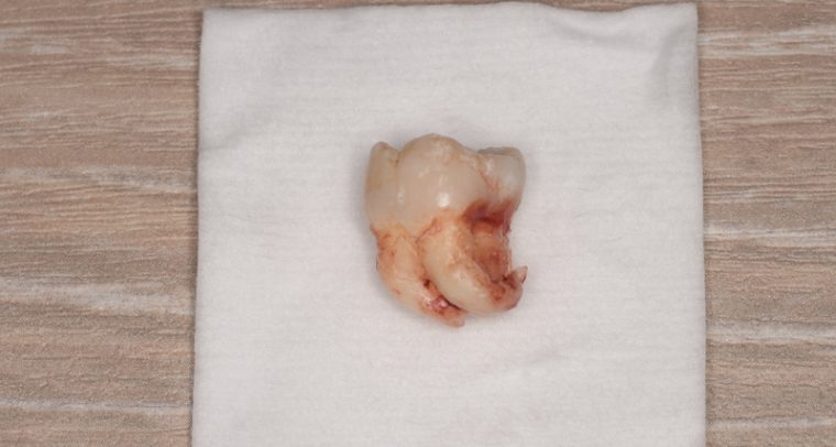 抜歯後の歯の写真