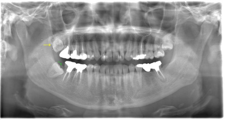 術前のレントゲン写真