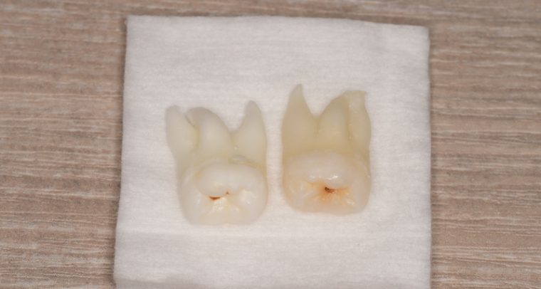 抜歯後の歯の写真