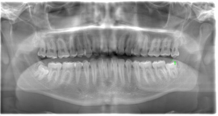 術前のレントゲン写真