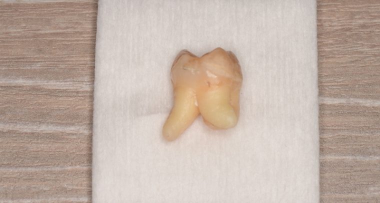 抜歯後の歯の写真