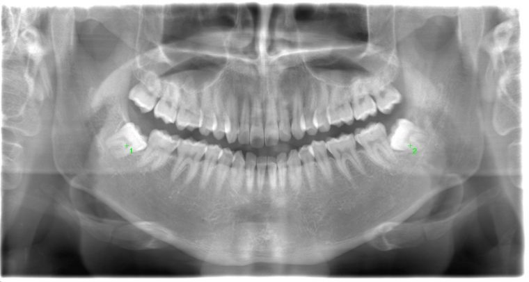 術前のレントゲン写真