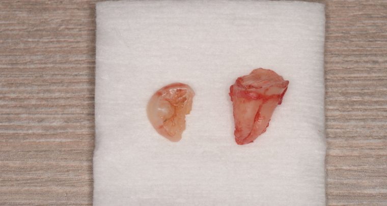 抜歯後の歯の写真