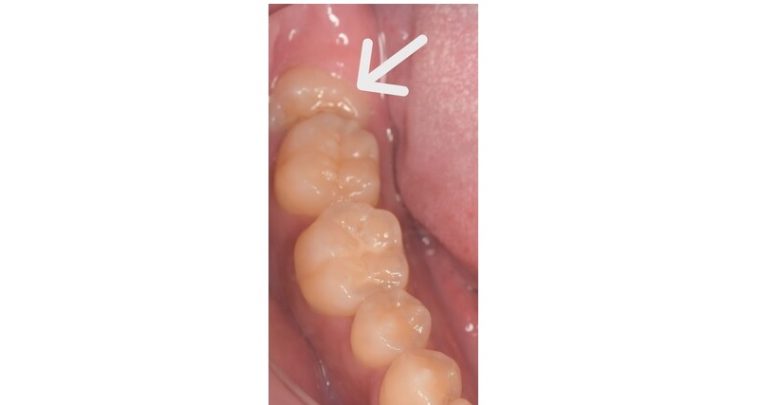 術前のレントゲン写真