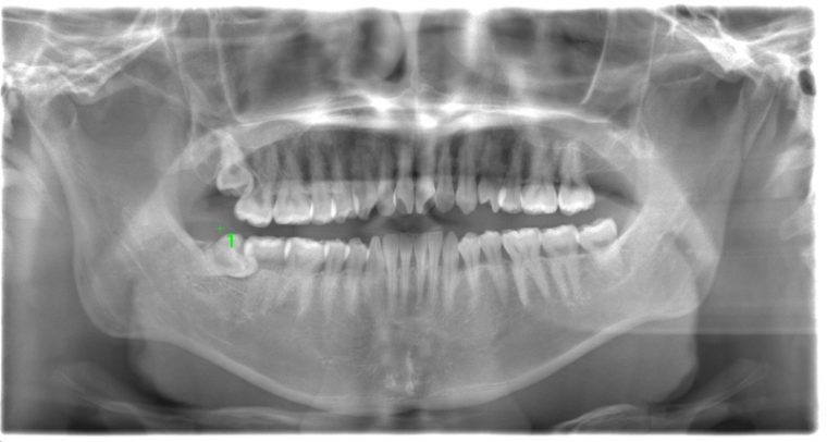 術前のレントゲン写真