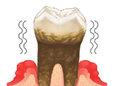 歯周病により揺れが強くなってしまった歯のイメージイラスト