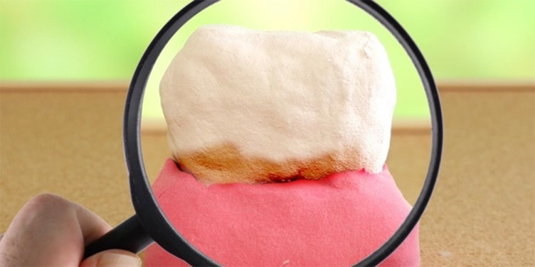 歯の汚れを虫眼鏡でアップしている画像