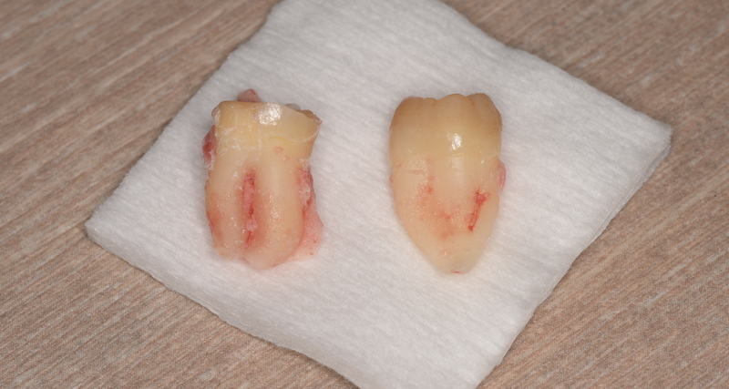 抜歯後の歯の写真