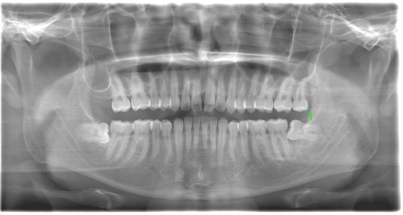 術前のレントゲン写真