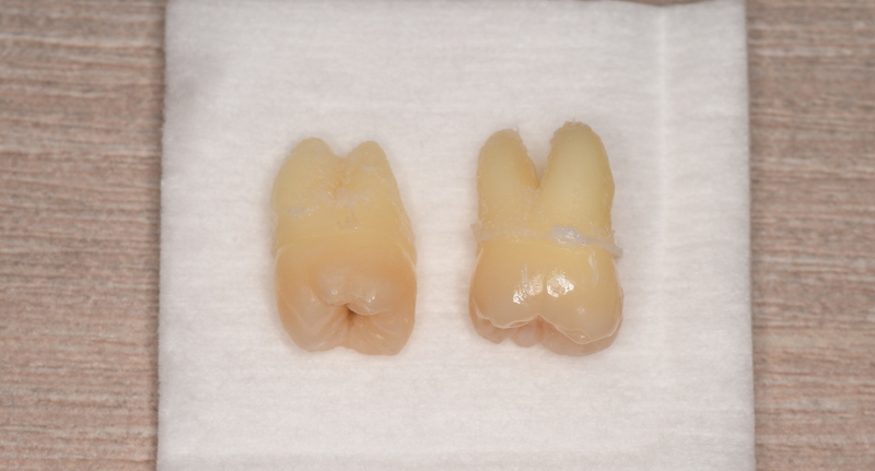 抜歯後の歯の写真