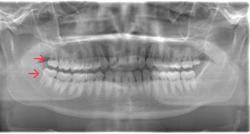 術前のレントゲン写真