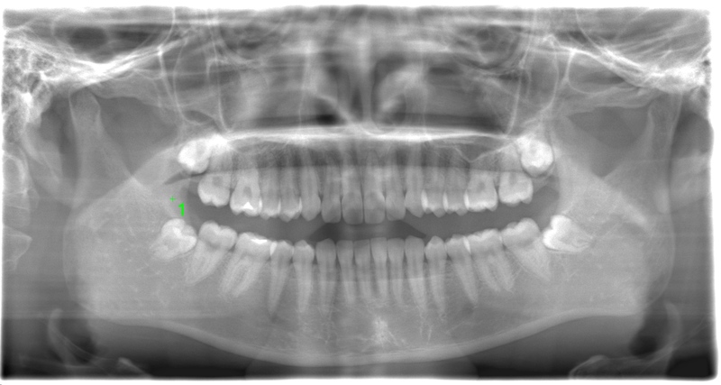 術前のレントゲン写真