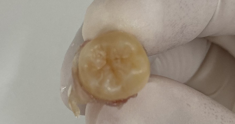 抜歯後の歯の写真