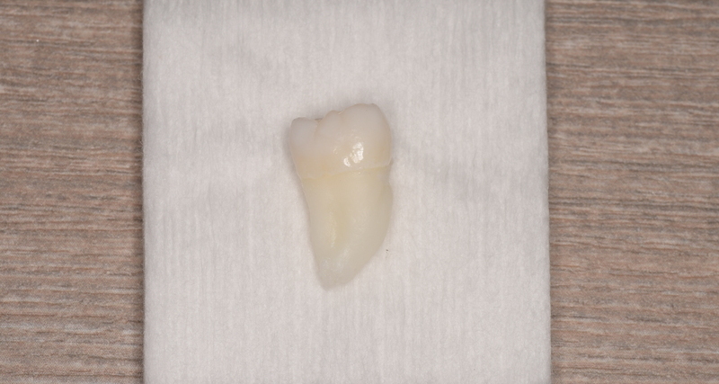 抜歯後の歯の写真