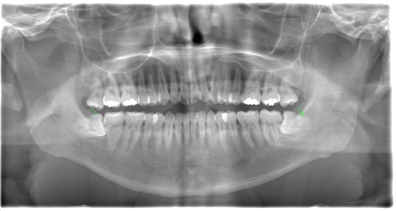 術前のレントゲン写真