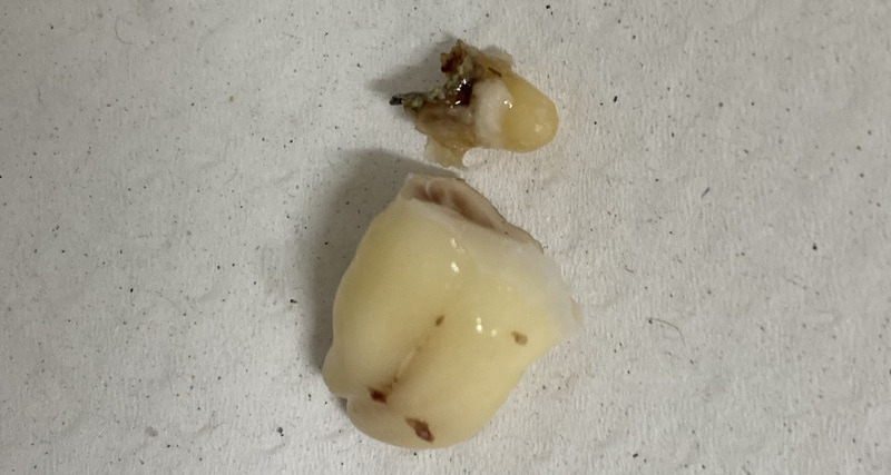 抜歯後の歯の写真