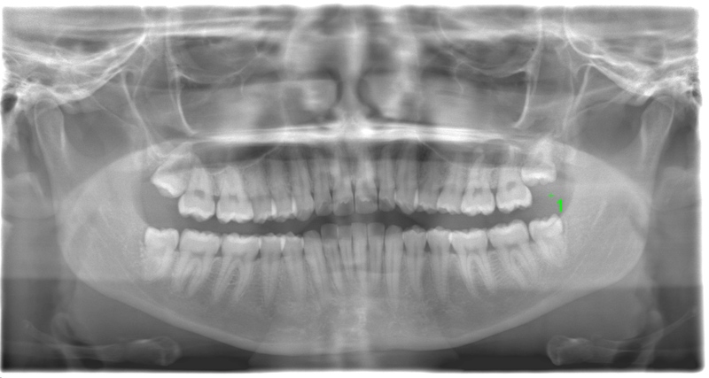術前のレントゲン写真