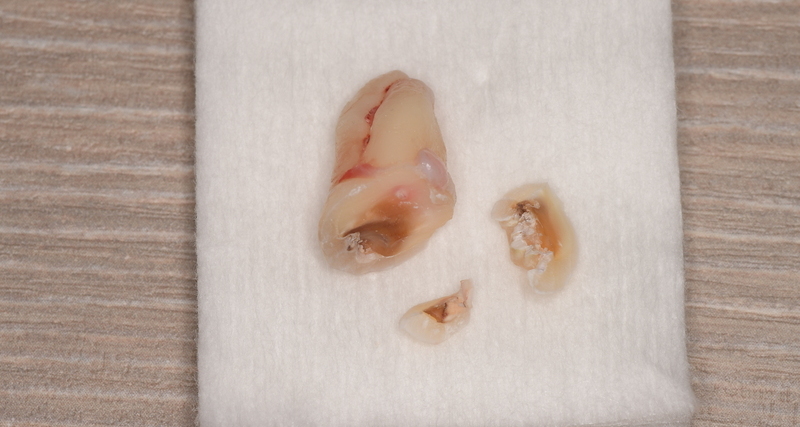 抜歯後の歯の写真