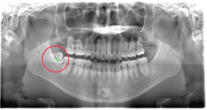 術前のレントゲン写真