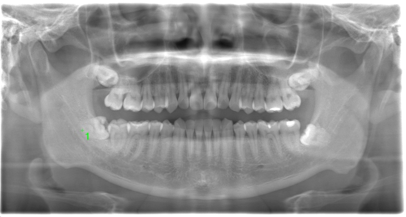 術前のレントゲン写真