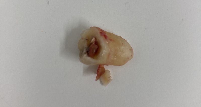 抜歯後の歯の写真