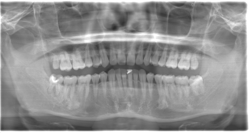 術前のレントゲン写真