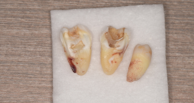 抜歯後の歯の写真