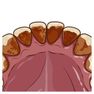 歯の表面についたステインがわかりやすい口の中のイメージイラスト