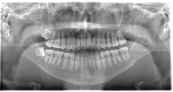 術前のレントゲン写真