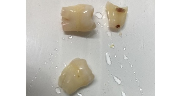 抜歯後の歯の写真