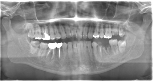 術前のレントゲン写真
