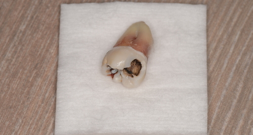 抜歯後の歯の写真