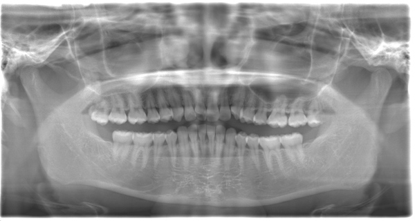 術前のレントゲン写真