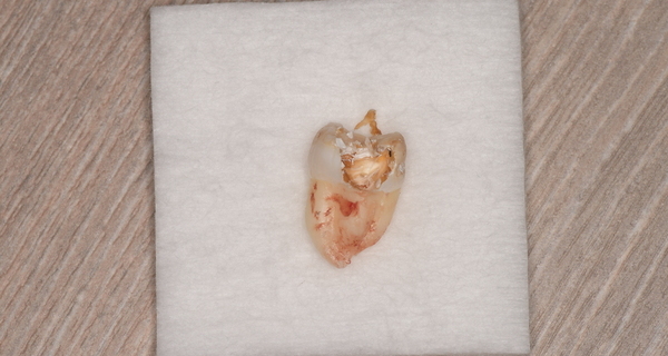 抜歯後の歯の写真