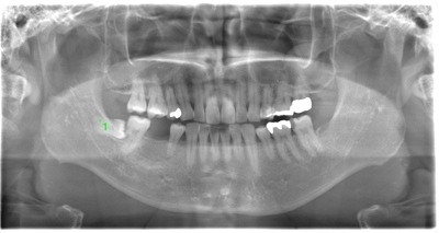 術前のレントゲン写真
