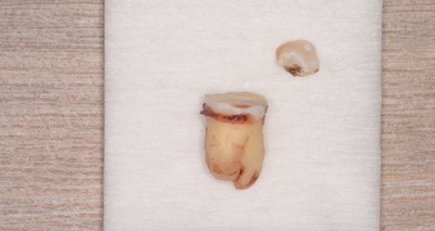 抜歯後の歯の写真