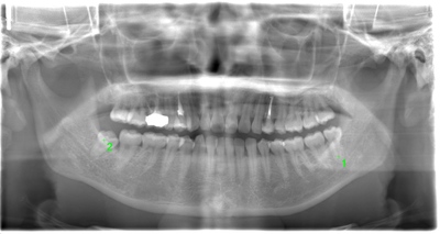 術前のレントゲン写真