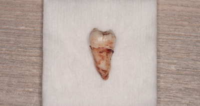 抜歯後の歯の写真