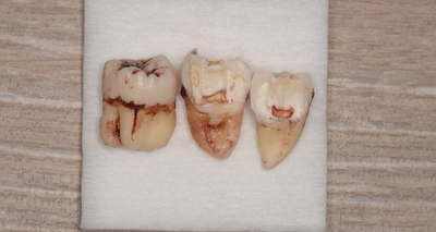 抜歯後の歯の写真