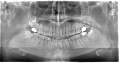 術前のレントゲン写真