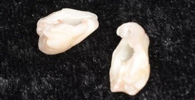 抜歯後の歯の写真