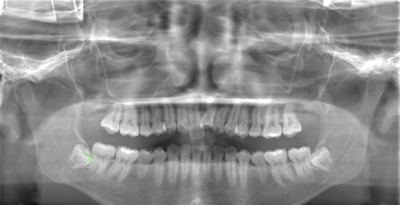 術前のレントゲン写真