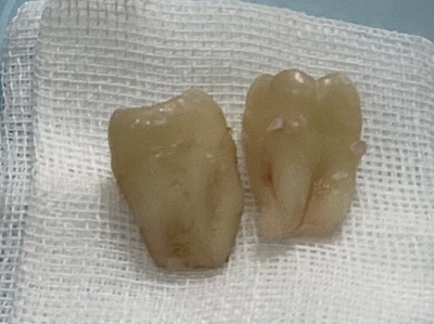 抜歯後の歯の写真