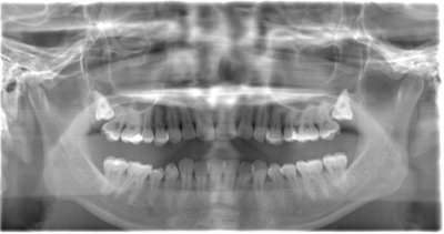 術前のレントゲン写真