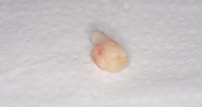 抜歯後の歯の写真