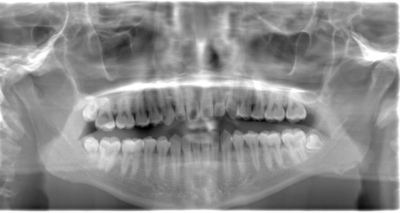 術前のレントゲン写真