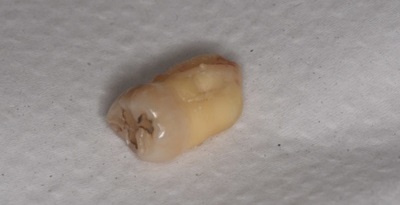 抜歯後の歯の写真