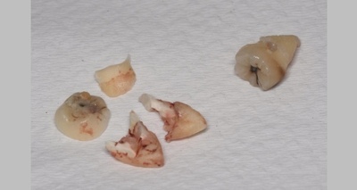 抜歯後の歯の写真