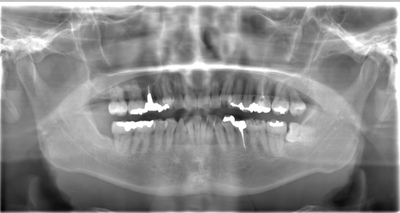 術前のレントゲン写真