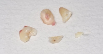 抜歯後の歯の写真